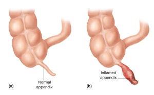 appendixcancer